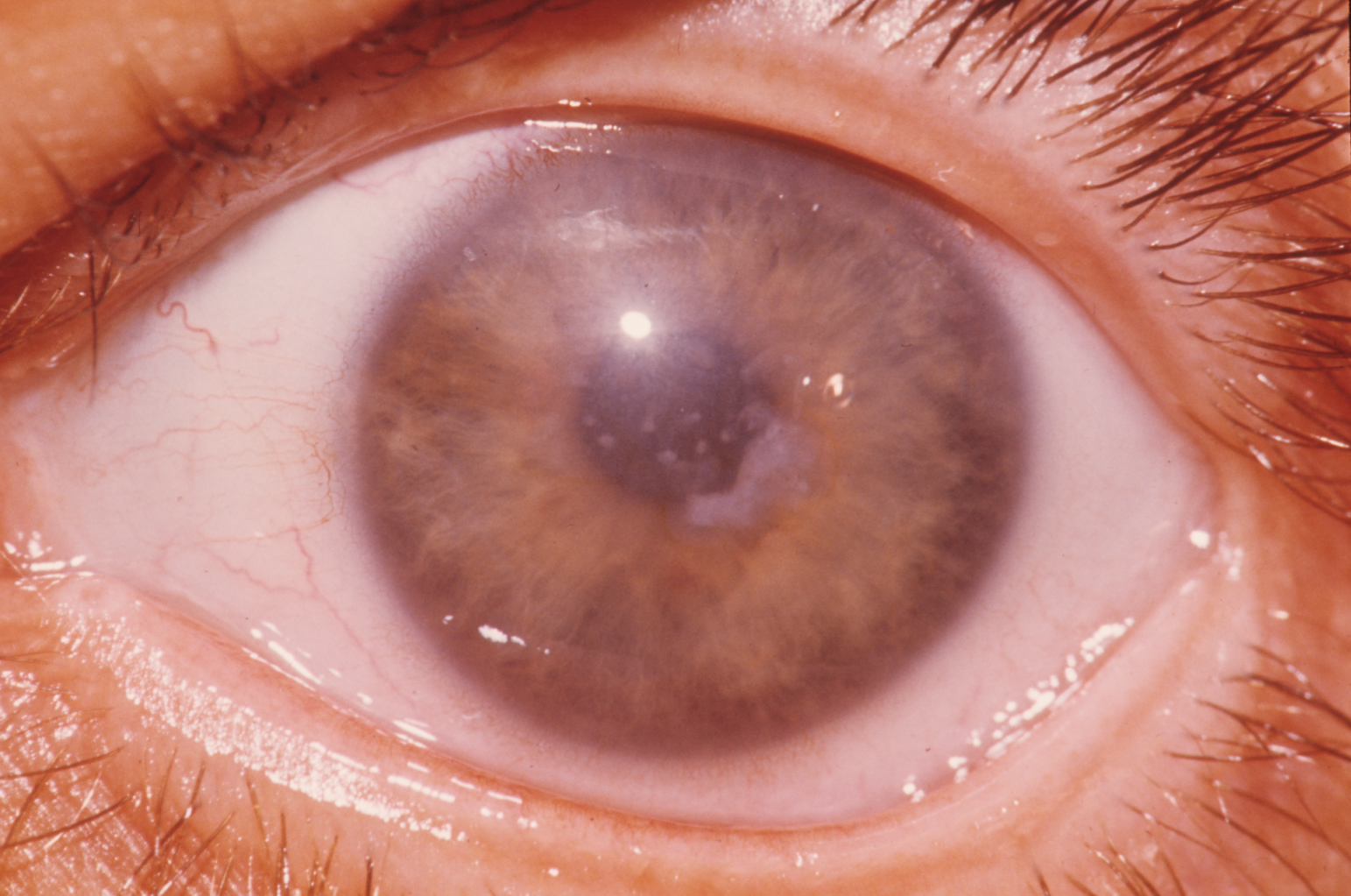 Corneal Disease