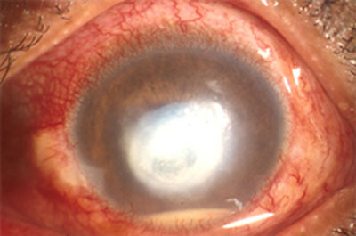 Corneal Disease