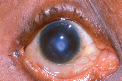 Corneal Disease