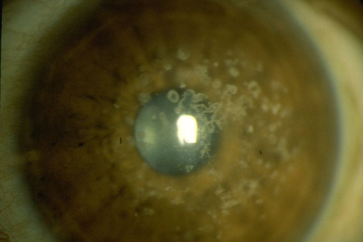 Corneal Disease