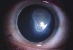 Corneal Disease