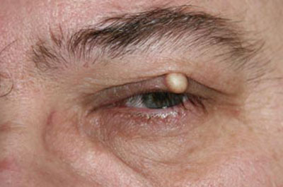 Eyelid Disorder