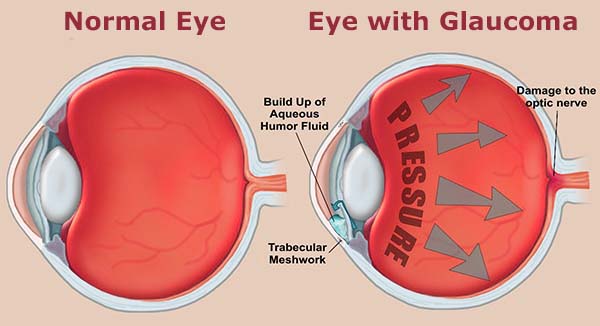 Glaucoma