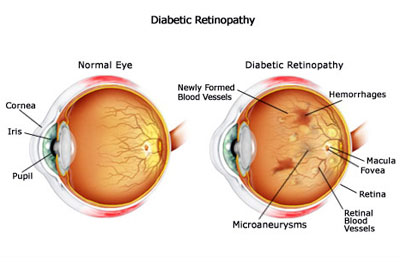 Diabetic Retinopathy