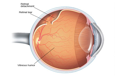 Retinal Detachment
