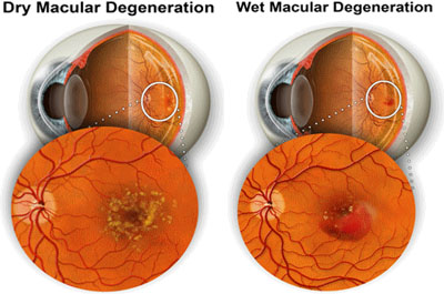 Macular Degeneration